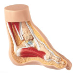 Clubfoot Model